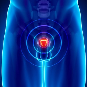 prostate-cancer-image