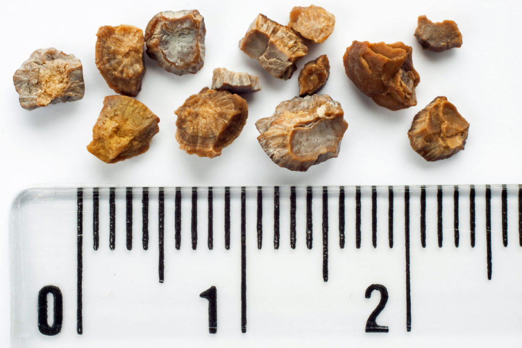 overflow incontinence kidn3y stones overflow incontinence kidn3y stones